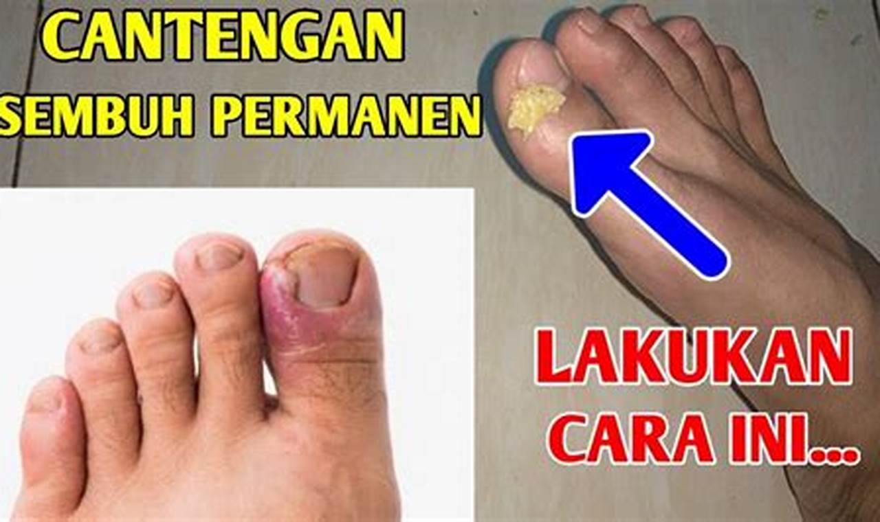 cara mengatasi kaki cantengan